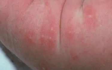 楊浩康(Yeung Ho Hong)醫生講解新生兒蕁麻疹/毒性紅斑(Erythema Toxicum)